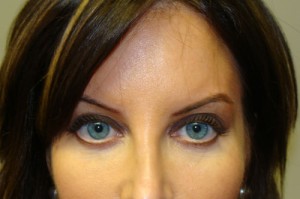 Blepharoplasty Before and After | Grover Aesthetics