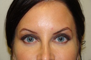 Blepharoplasty Before and After | Grover Aesthetics