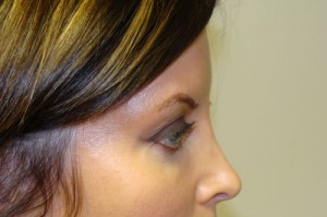 Blepharoplasty Before and After 20 | Grover Aesthetics
