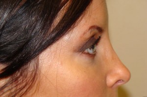 Blepharoplasty Before and After 20 | Sanjay Grover MD FACS