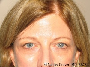 Blepharoplasty Before and After | Grover Aesthetics