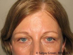 Blepharoplasty Before and After | Sanjay Grover MD FACS