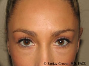 Blepharoplasty Before and After 18 | Sanjay Grover MD FACS