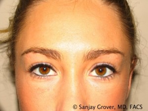 Blepharoplasty Before and After | Grover Aesthetics