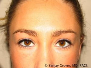 Blepharoplasty Before and After | Sanjay Grover MD FACS