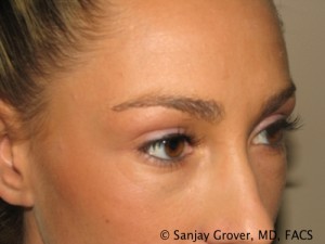 Blepharoplasty Before and After 22 | Sanjay Grover MD FACS