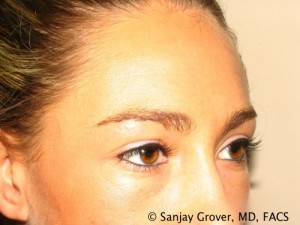 Blepharoplasty Before and After 22 | Sanjay Grover MD FACS