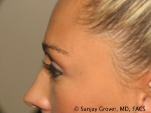 Blepharoplasty Before and After 22 | Grover Aesthetics