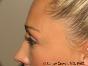 Blepharoplasty Before and After 22 | Sanjay Grover MD FACS