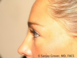 Blepharoplasty Before and After 22 | Grover Aesthetics