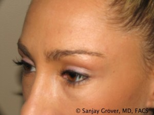 Blepharoplasty Before and After 22 | Sanjay Grover MD FACS