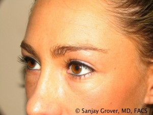 Blepharoplasty Before and After 22 | Sanjay Grover MD FACS