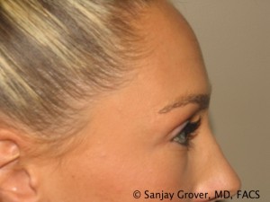 Blepharoplasty Before and After 22 | Grover Aesthetics