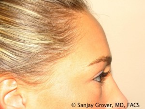 Blepharoplasty Before and After 22 | Grover Aesthetics