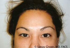 Blepharoplasty Before and After | Grover Aesthetics