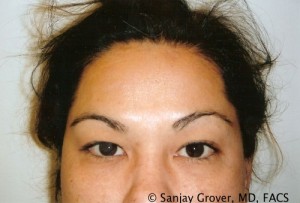 Blepharoplasty Before and After 24 | Sanjay Grover MD FACS