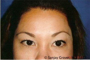 Blepharoplasty Before and After | Sanjay Grover MD FACS