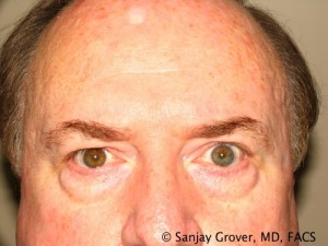 Blepharoplasty Before and After 27 | Sanjay Grover MD FACS