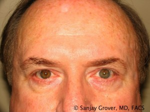 Blepharoplasty Before and After | Sanjay Grover MD FACS