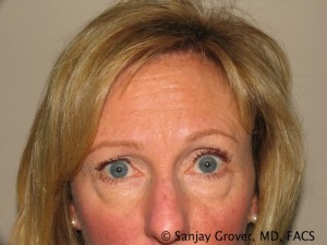 Blepharoplasty Before and After | Grover Aesthetics