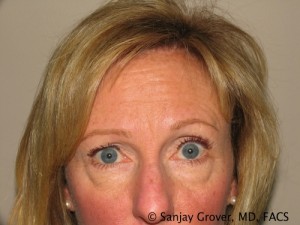 Blepharoplasty Before and After 20 | Sanjay Grover MD FACS