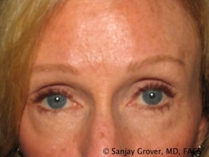 Blepharoplasty Before and After | Grover Aesthetics