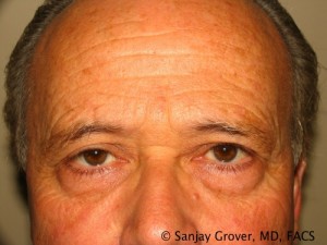 Blepharoplasty Before and After 10 | Sanjay Grover MD FACS
