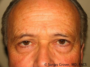 Blepharoplasty Before and After 29 | Sanjay Grover MD FACS