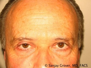 Blepharoplasty Before and After 26 | Sanjay Grover MD FACS