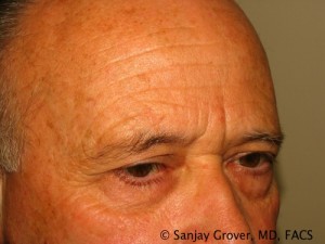 Blepharoplasty Before and After 26 | Sanjay Grover MD FACS