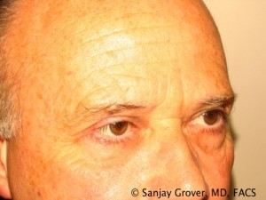 Blepharoplasty Before and After 26 | Sanjay Grover MD FACS