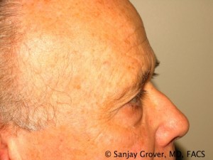 Blepharoplasty Before and After 26 | Sanjay Grover MD FACS