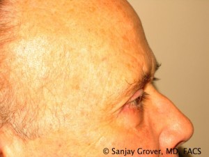 Blepharoplasty Before and After 26 | Sanjay Grover MD FACS