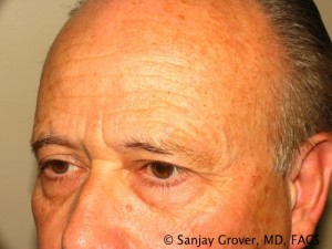 Blepharoplasty Before and After 26 | Sanjay Grover MD FACS