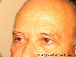 Blepharoplasty Before and After 26 | Sanjay Grover MD FACS