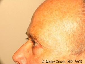 Blepharoplasty Before and After 26 | Sanjay Grover MD FACS