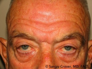 Blepharoplasty Before and After 30 | Sanjay Grover MD FACS