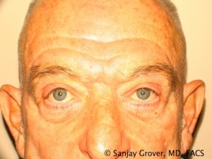 Blepharoplasty Before and After | Sanjay Grover MD FACS