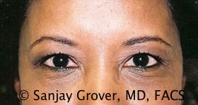 Blepharoplasty Before and After 21 | Sanjay Grover MD FACS