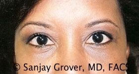 Blepharoplasty Before and After | Grover Aesthetics