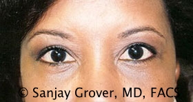 Blepharoplasty Before and After | Sanjay Grover MD FACS