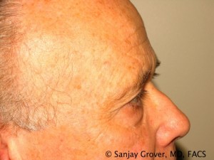 Blepharoplasty Before and After 28 | Grover Aesthetics