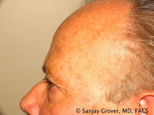 Blepharoplasty Before and After 28 | Grover Aesthetics