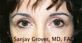 Blepharoplasty Before and After | Grover Aesthetics