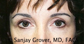 Blepharoplasty Before and After 29 | Sanjay Grover MD FACS