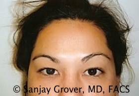 Blepharoplasty Before and After 11 | Sanjay Grover MD FACS