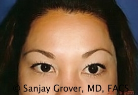 Blepharoplasty Before and After 30 | Sanjay Grover MD FACS