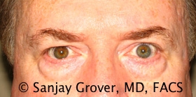 Blepharoplasty Before and After 06 | Sanjay Grover MD FACS