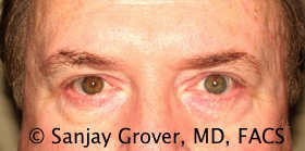 Blepharoplasty Before and After | Grover Aesthetics