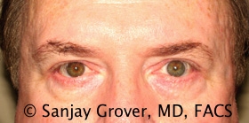 Blepharoplasty Before and After 31 | Sanjay Grover MD FACS